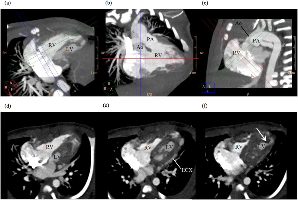 Journal of Pediatric Cardiology and Cardiac Surgery 1(1): 79-82 (2017)