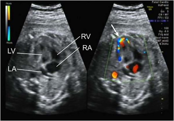 Journal of Pediatric Cardiology and Cardiac Surgery 1(1): 79-82 (2017)
