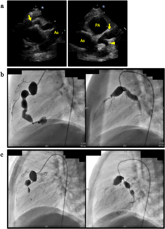 Journal of Pediatric Cardiology and Cardiac Surgery 4(2): 80-83 (2020)