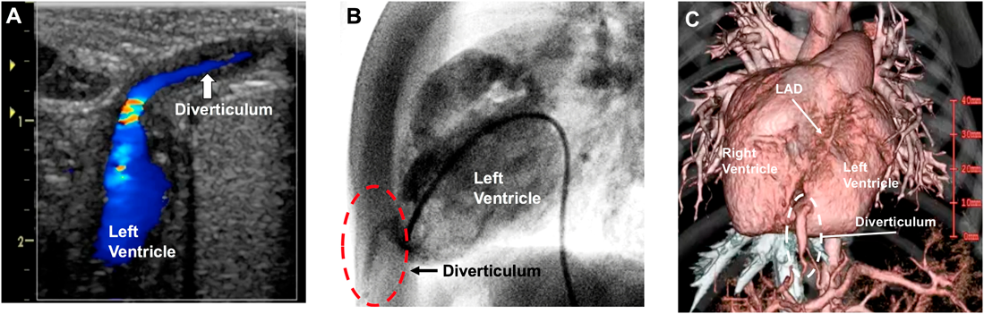 Journal of Pediatric Cardiology and Cardiac Surgery 5(1): 36-37 (2021)