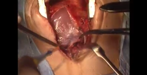 Journal of Pediatric Cardiology and Cardiac Surgery 5(1): 36-37 (2021)