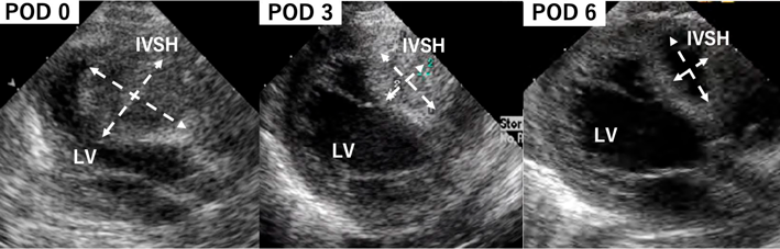 Journal of Pediatric Cardiology and Cardiac Surgery 7(2): 55-58 (2023)