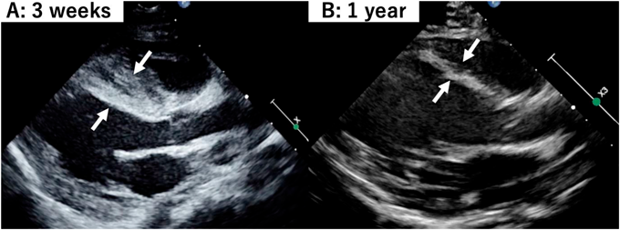 Journal of Pediatric Cardiology and Cardiac Surgery 7(2): 55-58 (2023)