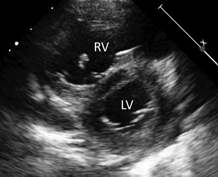 Journal of Pediatric Cardiology and Cardiac Surgery 9(2): 159-161 (2025)